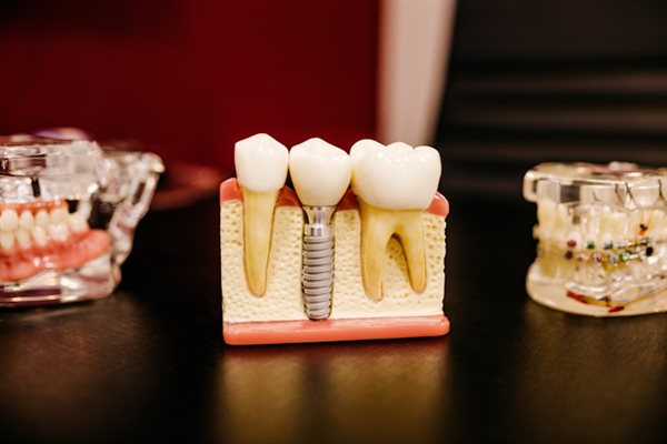 Implante Dentário